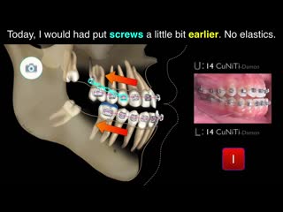 My perspective on digital orthodontics part 6 ортодонтия