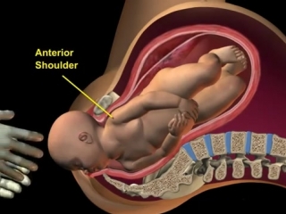 Ant shoulder dystocia