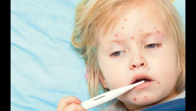 Спалах кору в україні що потрібно знати про підступну хворобу