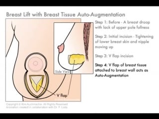 Breast lift with auto augmentation fat transfer augmentation