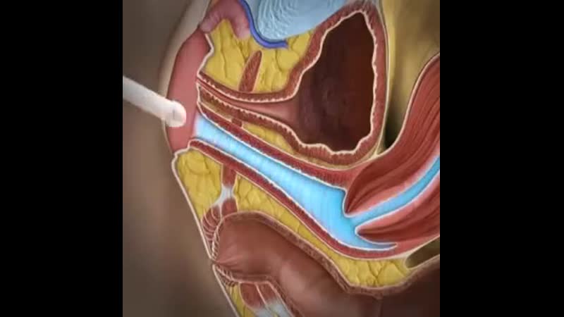 Узи малого таза