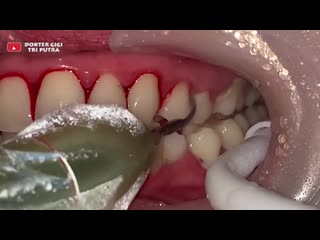 Удаление зубного камня