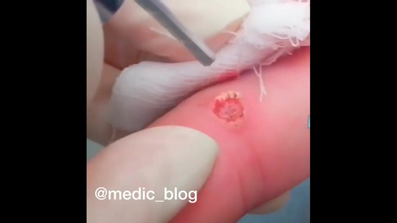 Лазерное удаление бородаи