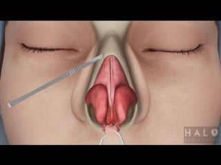 Medical animation rhinoplasty