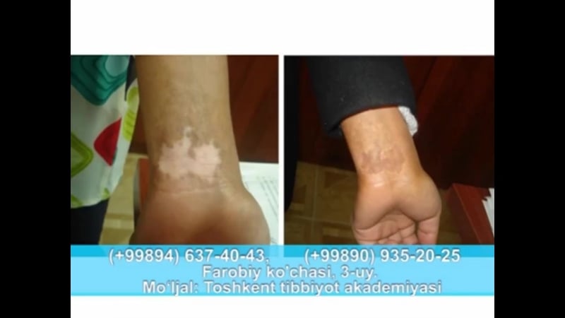 Витилиго лечение витилиго и белых пятен в узбекистане
