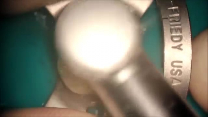 First maxillary molar endodontic acces cavity