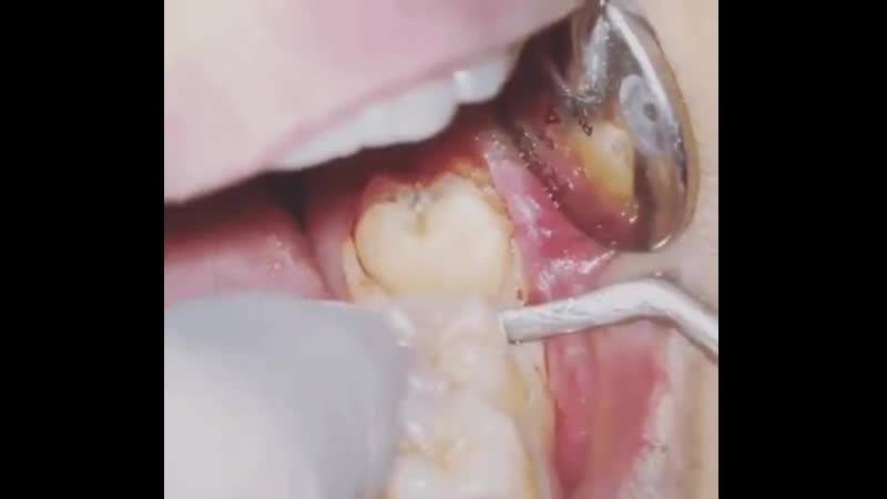 💊 удаление зуба мудрости