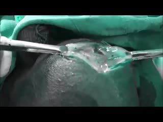 Scrotal lymphedema musick vid