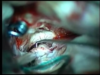 85 клипирование аневризмы пса