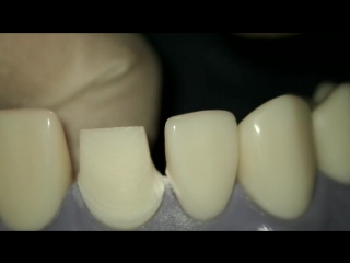 #8 tooth prep