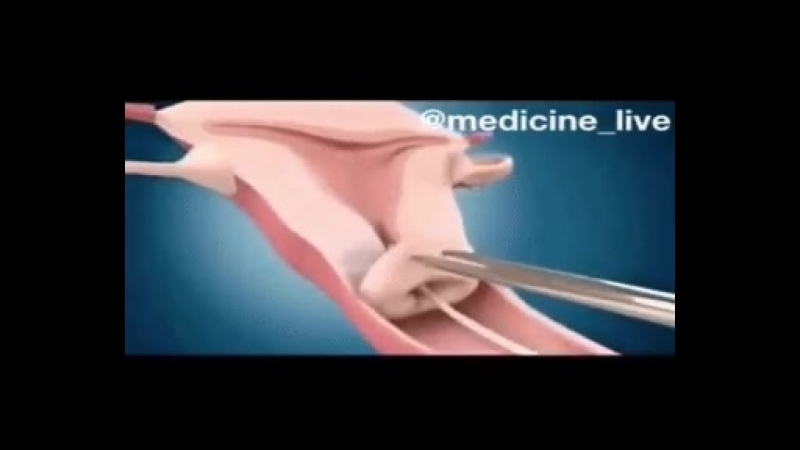 Внутриматочная спираль (вмс)