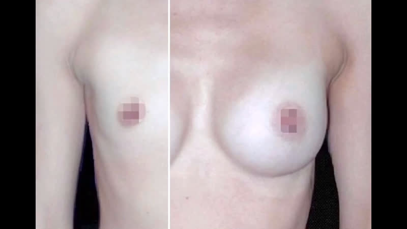 Увеличивающая маммопластика круглыми имплантами