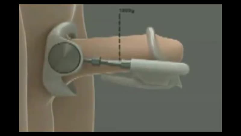 Экстендер – самый эффективный способ увеличения члена!