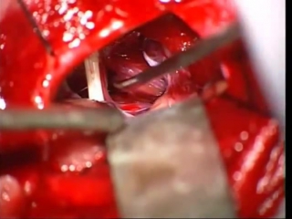 62 микроваскулярная декомпрессия тройничного нерва