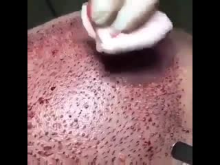 Пересадка волос