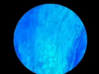 Подкожные клещи