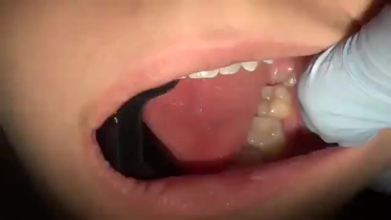 Удаление зуба мудрости removal of wisdom teeth (360p) mp4