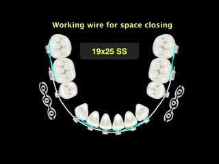 My perspective on digital orthodontics part 3 ортодонтия