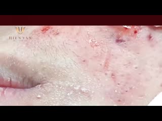 Черные точки, корочки, воспаленные прыщи