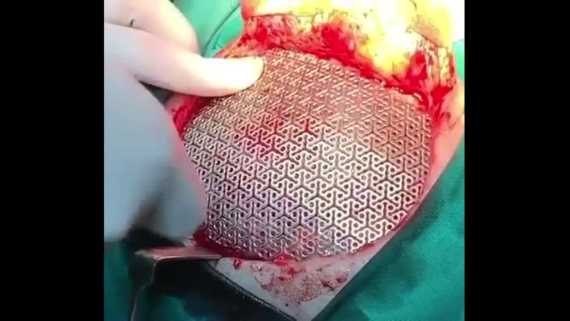 Протезирование костей черепа